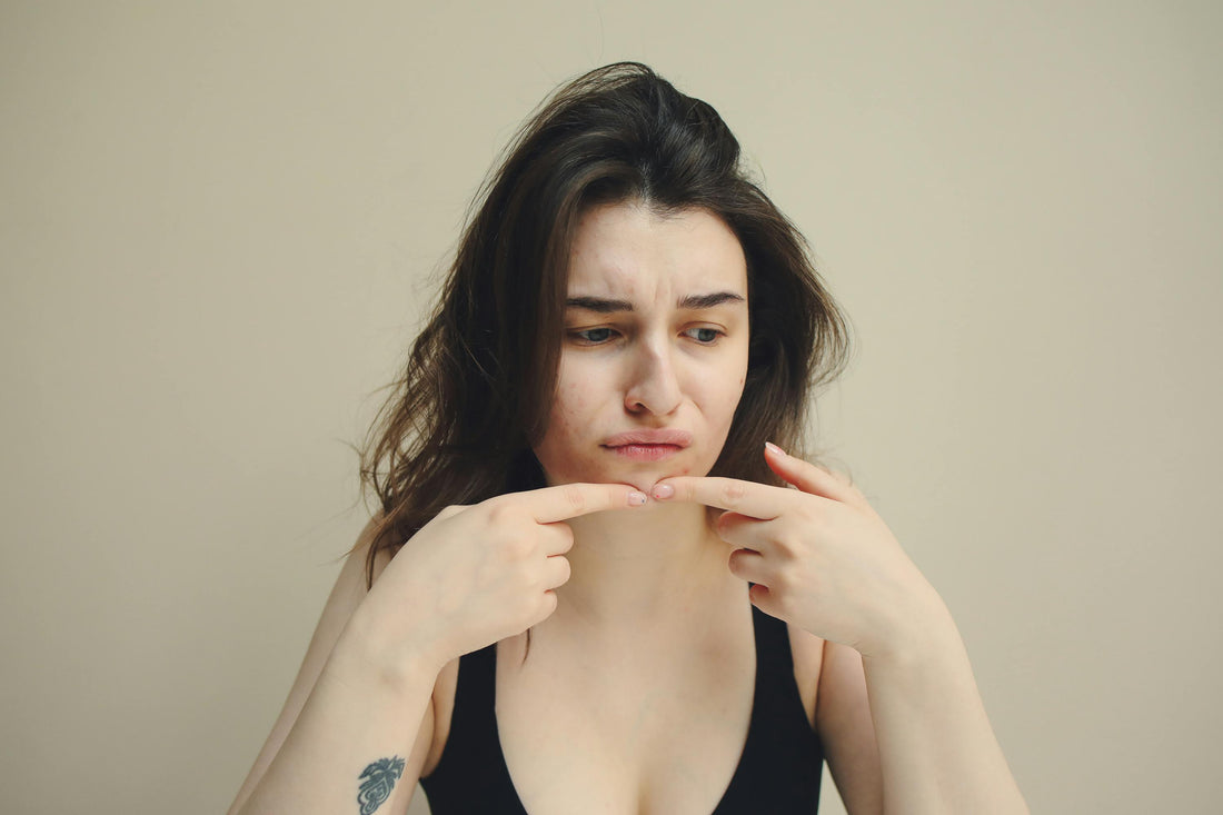 Why You Break Out Before Your Period (And What Your Body Is Trying to Tell You)